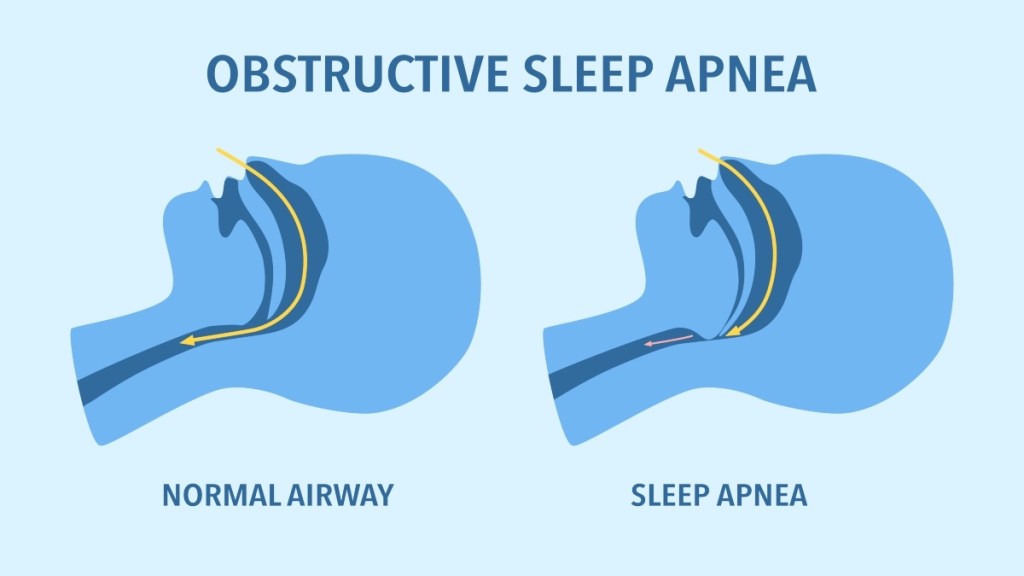 An illustration of sleep apnea, which can cause snoring