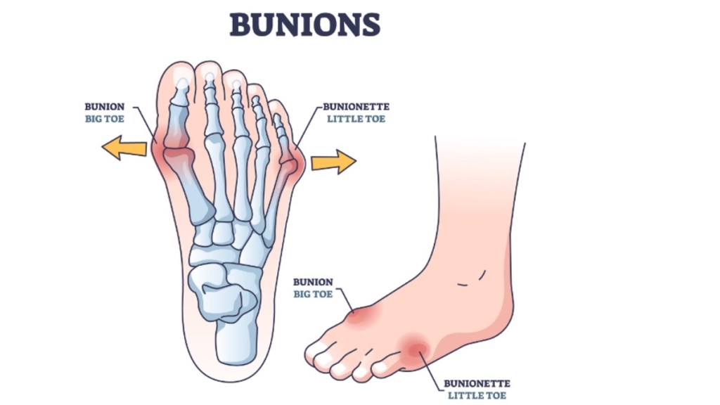 An illustration of a tailor's bunion and standard bunion