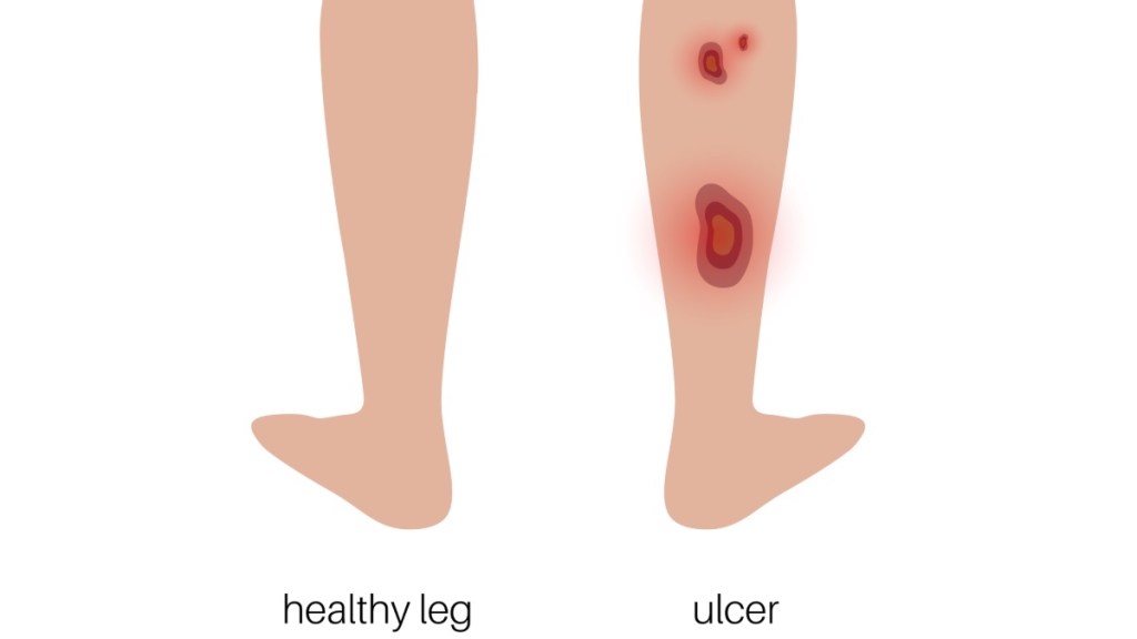 An illustration of skin ulcers on a leg