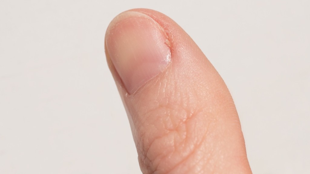 A close-up of a finger with a hangnail, which is not yet infected