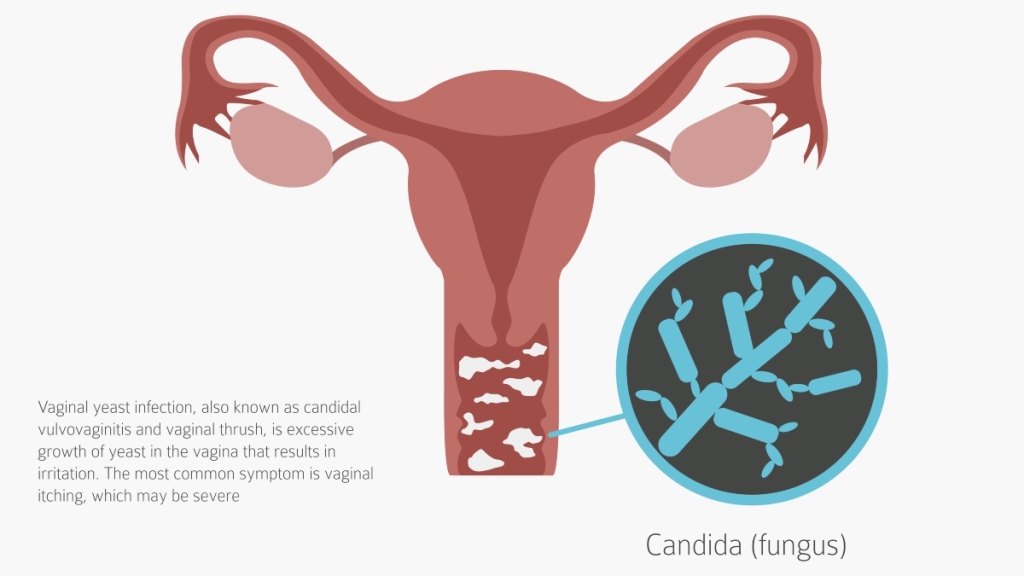 An illustration of a vaginal yeast infection