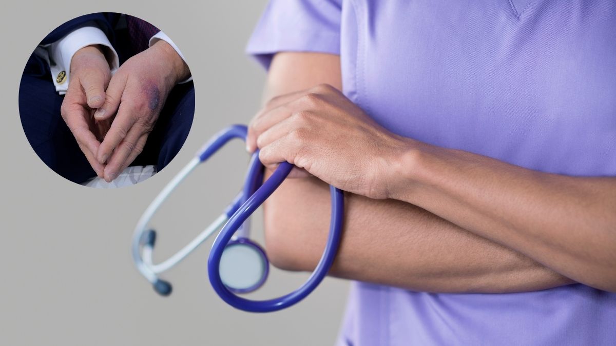 hand bruising causes