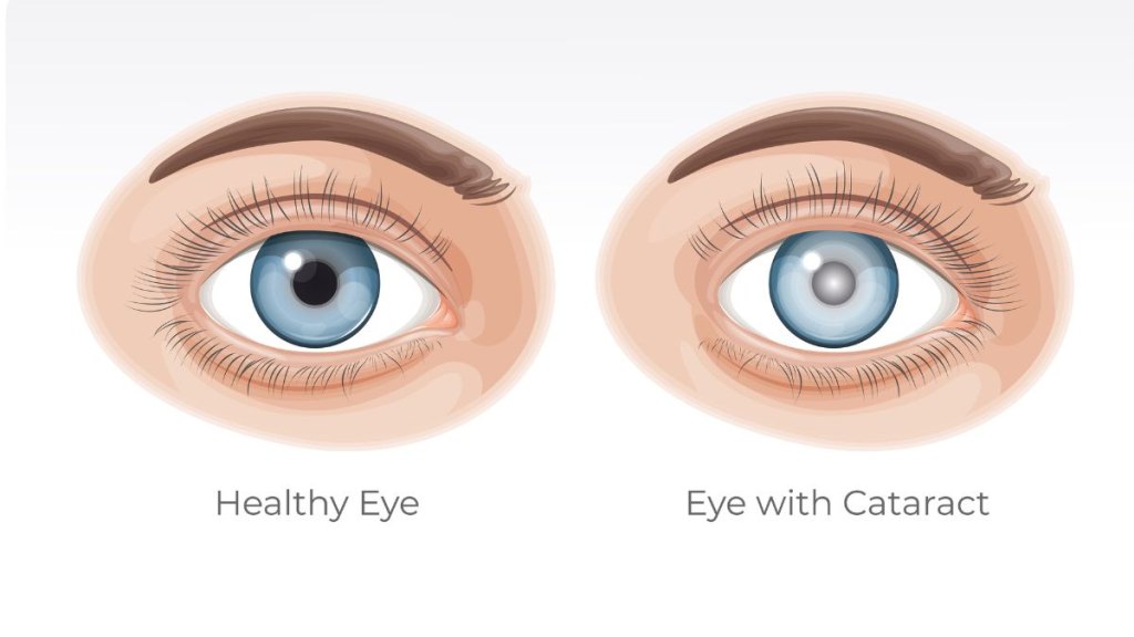 Human Healthy Eye and Eye with Cataract