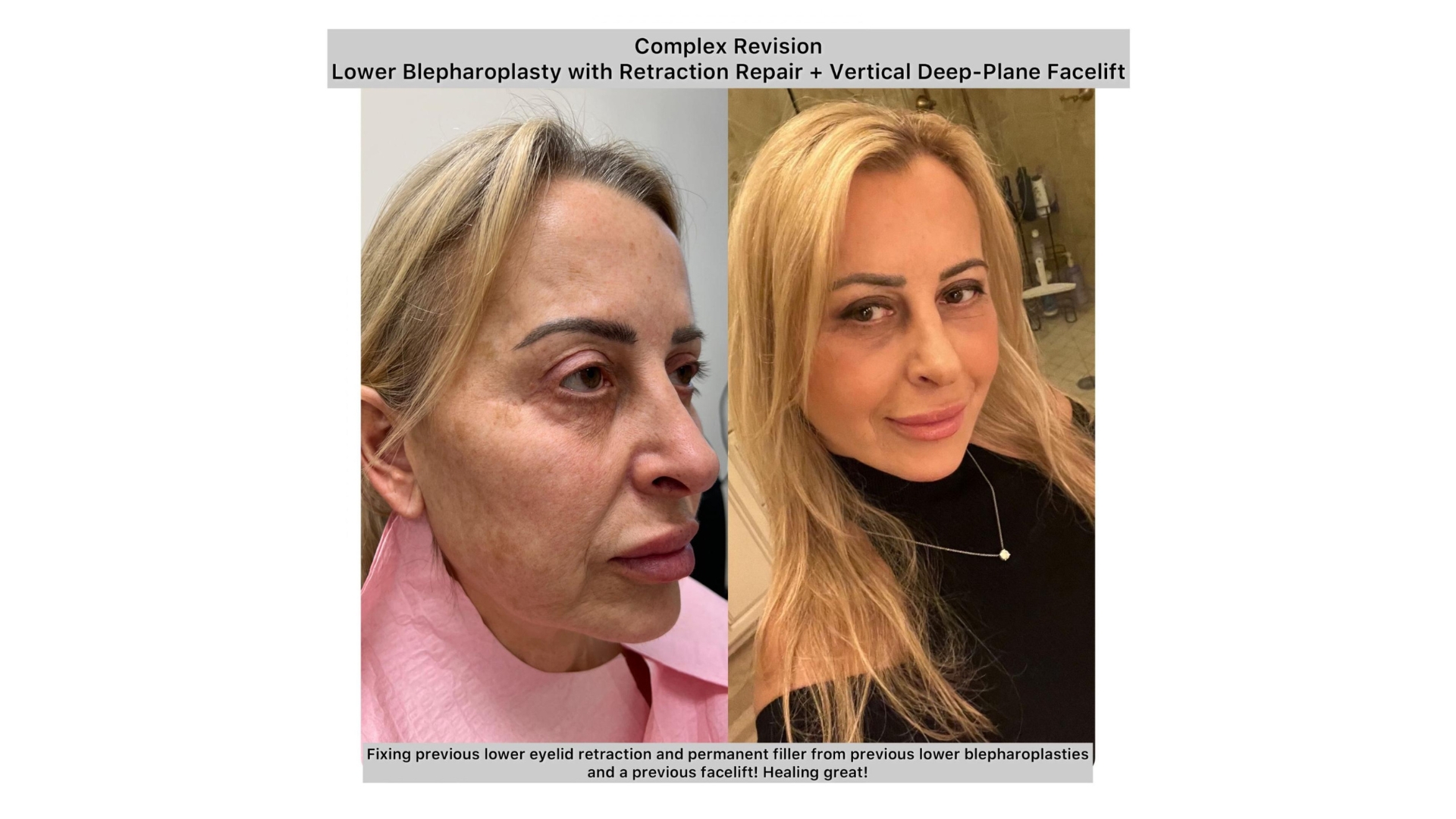 JIYA founder Dr. Jindal is advancing minimally invasive upper eyelid rejuvenation techniques.