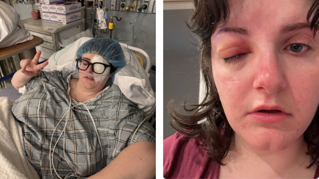 Carissa Mosness after her fourth eye surgery