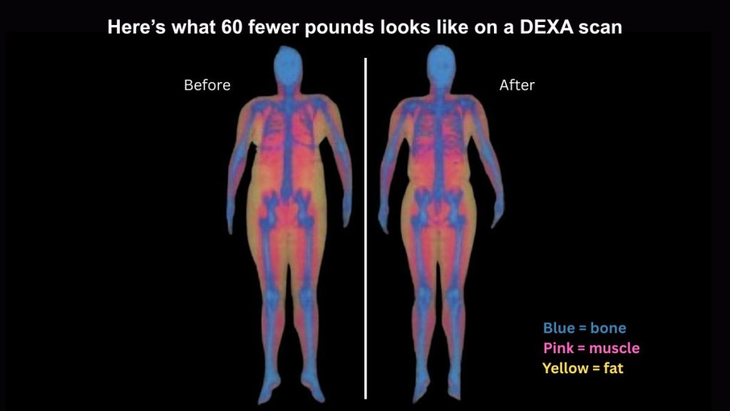 Color-coded DEXA body scans glow blue for bone, pink for muscle and yellow for fat.